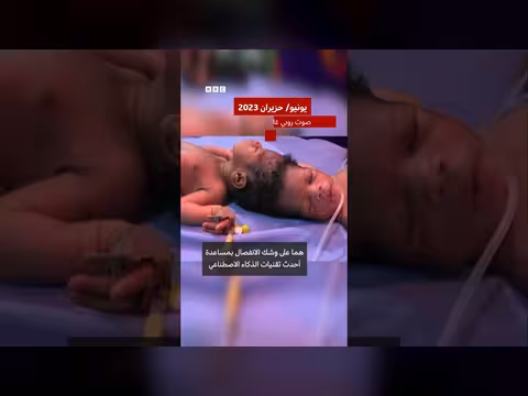 فصل توأمين ملتصقتين باستخدام الذكاء الاصطناعي