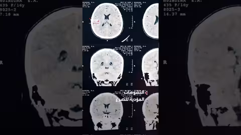 الذكاء الاصطناعي يساعد في جراحات علاج الصرع للأطفال: تطوير أسترالي