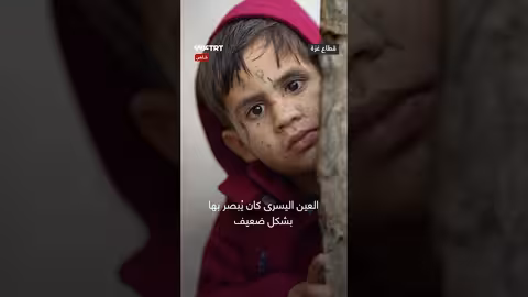 تشوّه في وجه طفل فلسطيني وفقدان بصر جزئي بعد قصف إسرائيلي